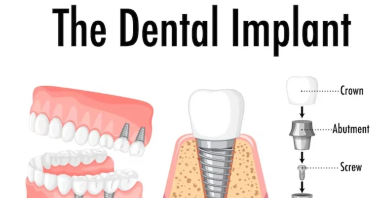 Dental Implants