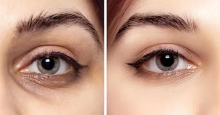Blepharoplasty