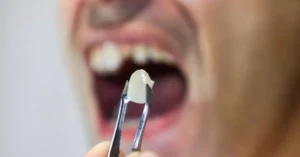 Tooth extractions are one of the most routine procedures in modern dentistry.